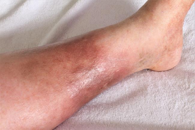 שינויי צבע בעור הרגליים בשל אי ספיקה ורידית 